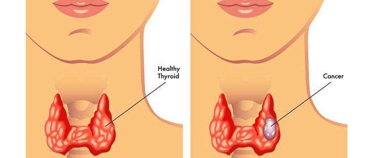 甲狀腺結節會癌變的幾種情況