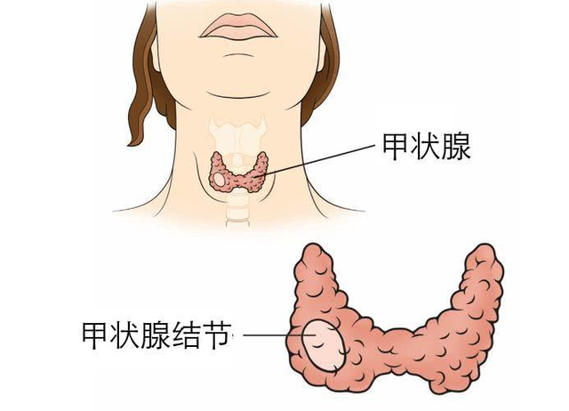 塞克陸德碘元素自動檢測儀檢測甲狀腺結節的誘因